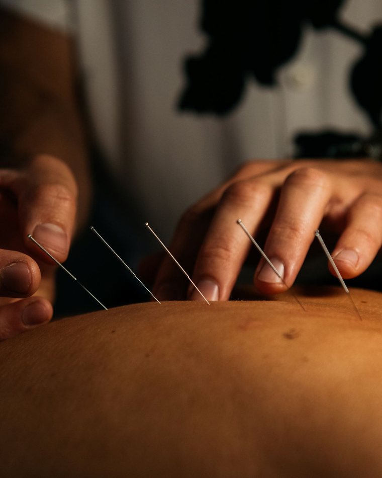 Classical channel needling along the back at Gateway, Hillcrest San Diego