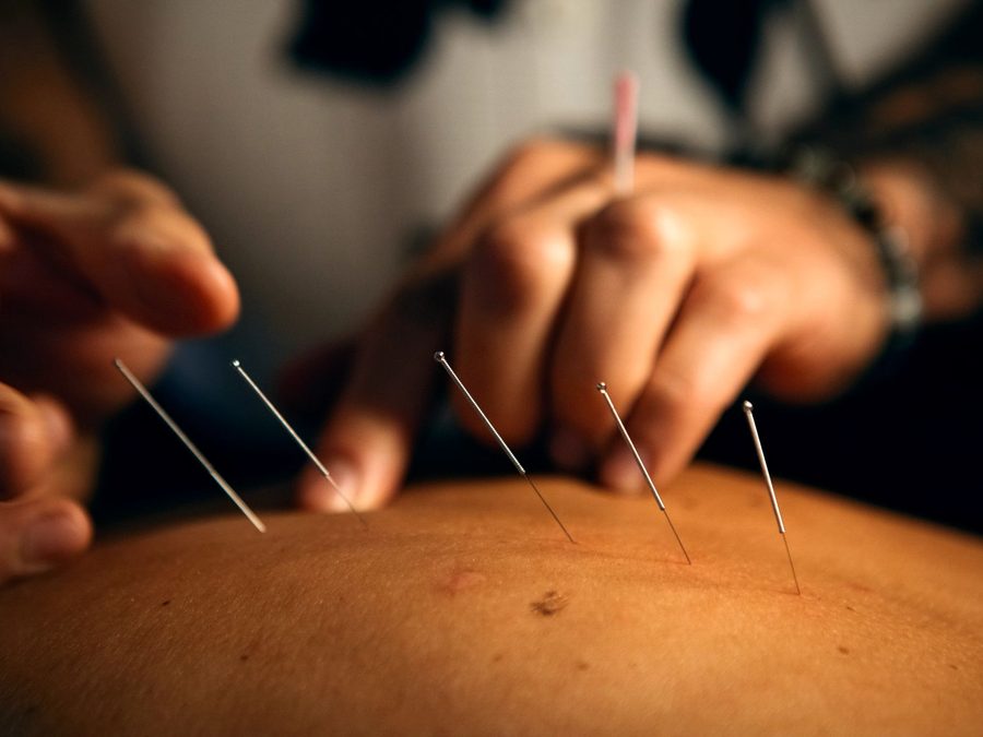 Classical needling at Gateway: the work begins