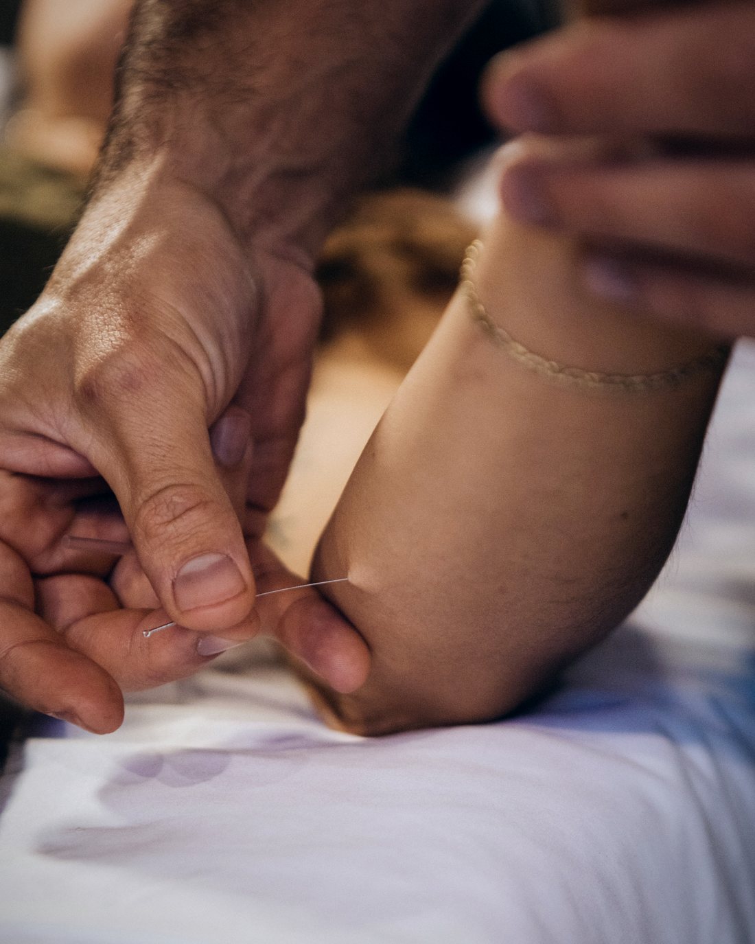 Sinew channel needling at the elbow during an acute injury treatment at Gateway